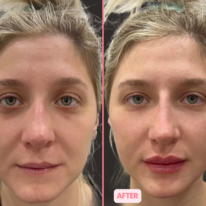 MicroGlow Eye Patches