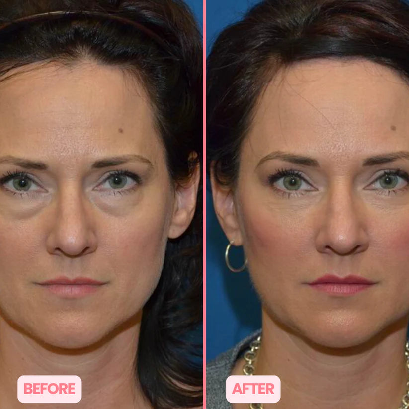 MicroGlow Eye Patches